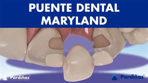 puente de maryland dental